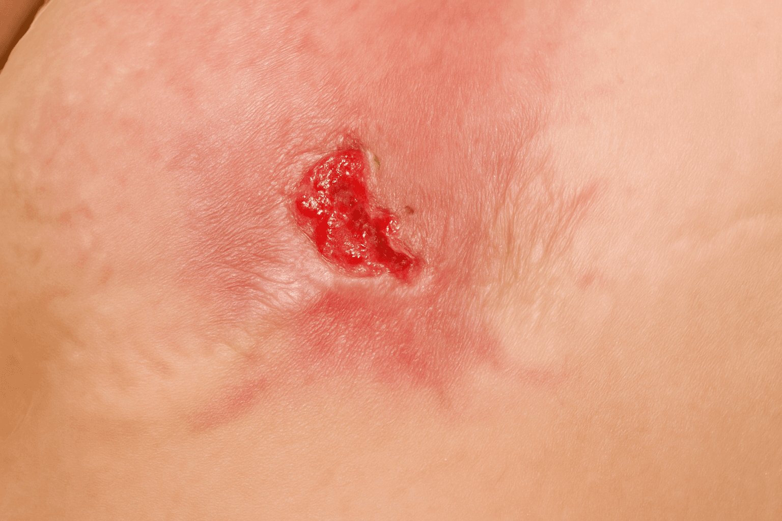 Skin Lesion Removal (Cysts & Lipomas)